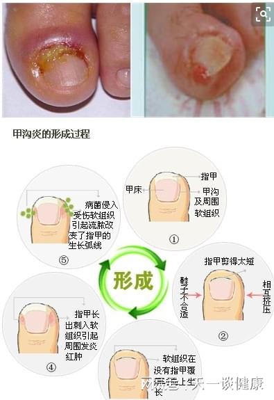 甲沟炎预防与舒缓小妙招大全，生活实用指南